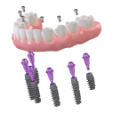 Вернуть все зубы  на 4х или 6ти  имплантатах Straumann и Временный протез в подарок